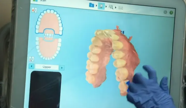 intraoral 3D scan